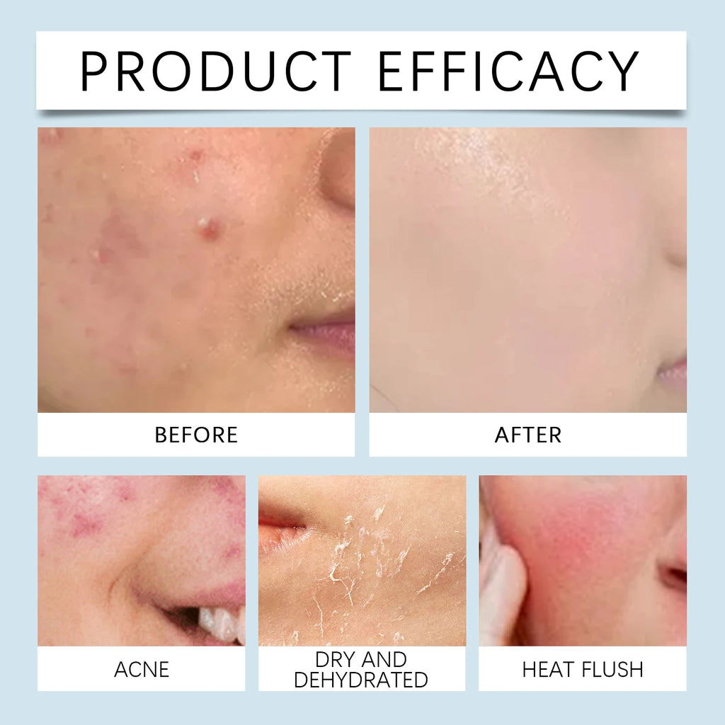 0.25mm Micro Needle Essence Hyaluronic Acid Microneedle Roller Facial Hydrating Brightening Pore Refining Beauty Skin Care Serum